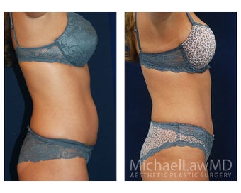 Abdominoplasty - Tummy Tuck 396068