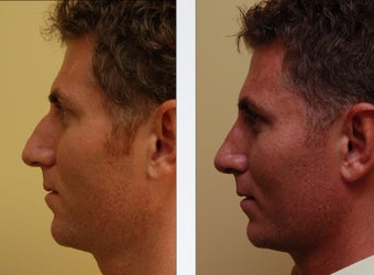 Rhinoplasty before 314277