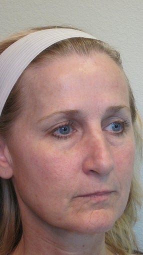 Sculptra and juvederm before 582244