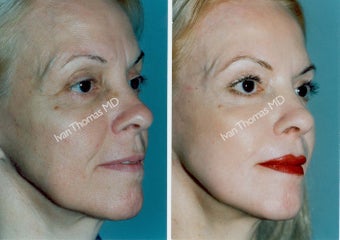 Non-Surgical Face Lift- Exoderm before 242980