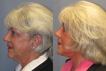 Lite Lift, Liposuction of the neck, Brow Lift, Blue Peel before 523496