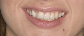 porcelain veneers before 363976