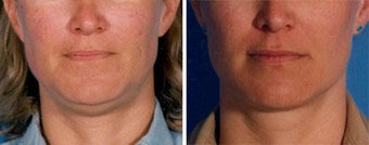 Chin Liposuction before 640676
