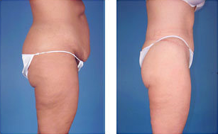 Central body lift with liposuction age 38 after 6816