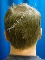 Ear Surgery (Otoplasty) 584567