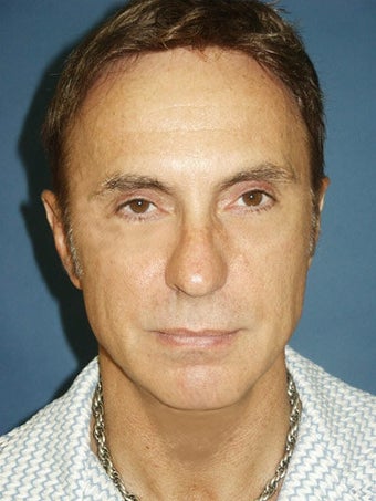 Chin augmentation, bilateral upper and lower blepharoplasty with canthopexy, and soft tissue fillers to the nasolabial folds before 250250