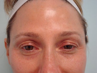 "No-Lift" Eye Lift with Portrait PSR and Filler Injection before 583358