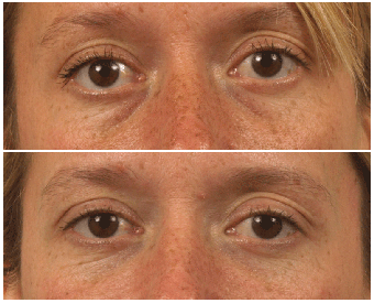 Restylane to Lower Eyelids/Tear-Trough before 467145