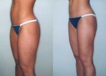 Liposuction (Thighs, Knees & Buttocks) before 350940