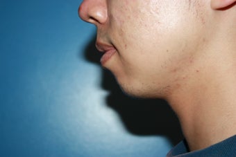 Chin augmentation before 546575