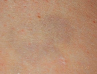Laser tattoo removal after 374510