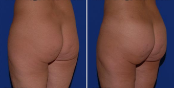 Brazilian Butt Lift after 494509
