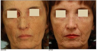 Facial Reconstruction before 136845