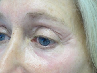 Portrait Plasma Resurfacing after 580576