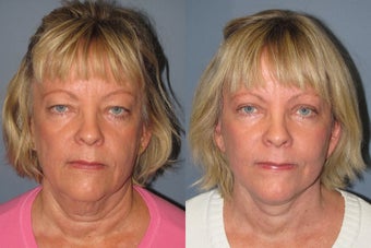 Lite Lift, Liposuction of the neck, eyelid lift after 523504