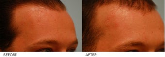 Scar Revision after 220191