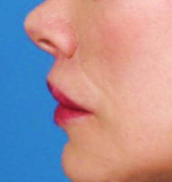 Lip lift 519741