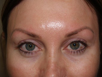 Eyebrow transplant before 174845