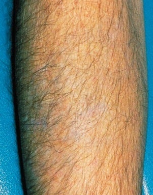 Laser tattoo removal after 374505