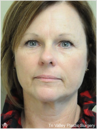 Facelift before 420926