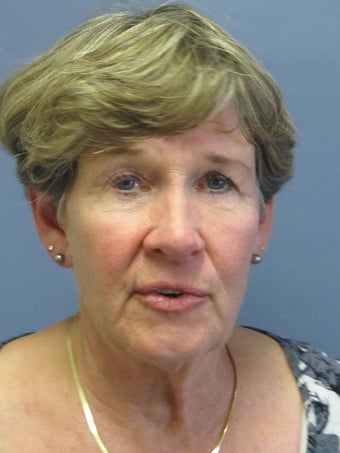 Neck Lift, Platysmaplasty before 634749