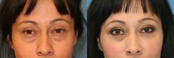 Fat removal of lower lid and fat transfer to cheeks before 251678