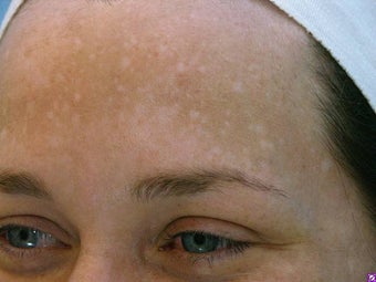 Melasma Treatment before 590841