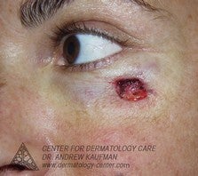Mohs Surgery of Basal Cell Carcinoma and Recontruction before 315051