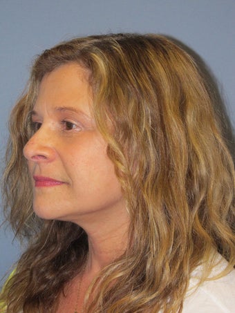 Neck Lift, Platysmaplasty 634725