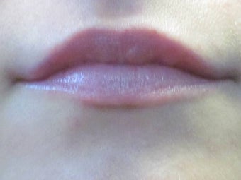 Lip Augmentation after 379519