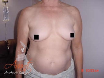 Body Jet before 379521