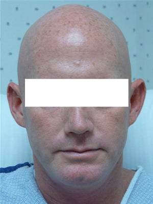 Ear Surgery (otoplasty) before 135827