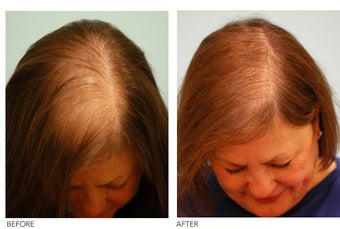 Female Hair Transplant before 133426