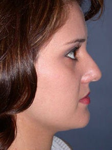 Nose Surgery, Rhinoplasty 550008