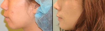 Chin Augmentation before 649424