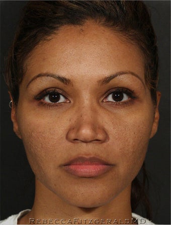 Sculptra & eMatrix after 319350