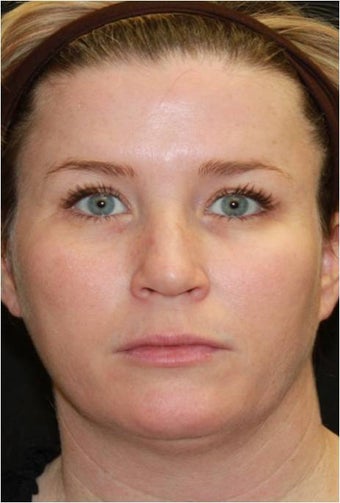 Ultherapy after 445623