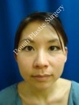 Ear Surgery (Otoplasty) before 579104