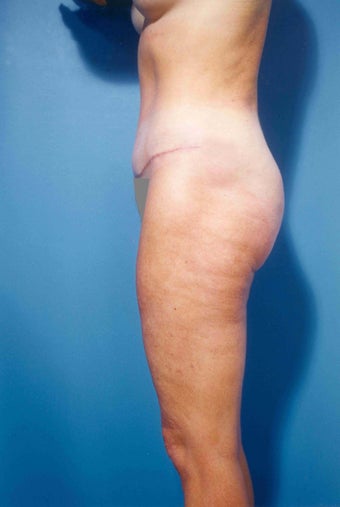 Abdominoplasty after 356390