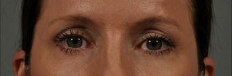 Ultherapy after 541293