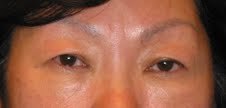Asian Eyelid Surgery before 613751