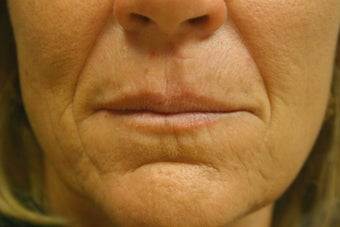 Restylane before 451760