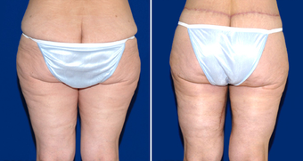 Thigh Lift after 495818