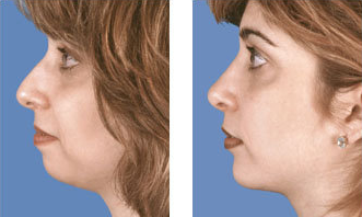 Rhinoplasty with chin implant front view after 6770