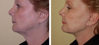 Necklift before 359787