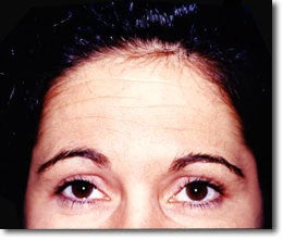 BOTOX before 650563