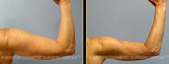 Vaser Liposuction before 561794