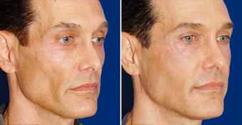 Sculptra after 496295