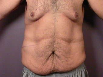 After Weight Loss before 280818
