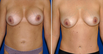 Breast Implant Removal before 495858